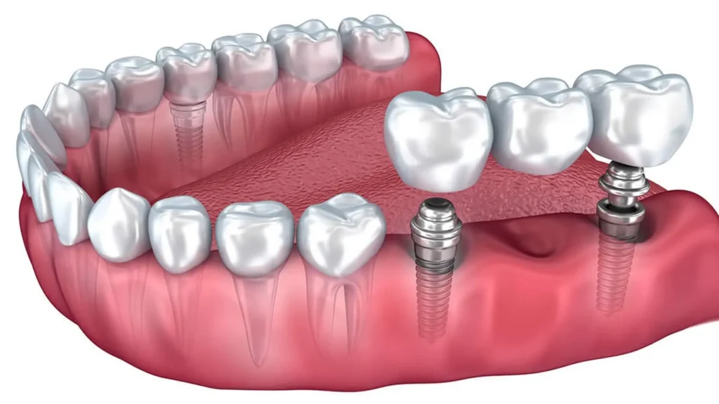 Implant or Bridge for a Single Missing Tooth: A Practical Decision Framework