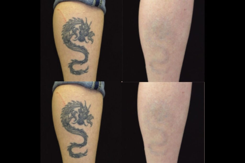 How to Fade a Tattoo Before a Cover Up How to Fade a Tattoo Before a Cover Up